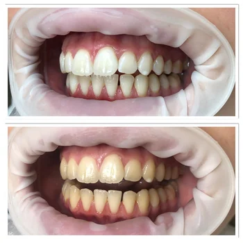 Luxsmile 35%HP Set Za Izbjeljivanje Zubi Profesionalno-Izbjeljivanje Zubi u Samo 30 Minuta Pogodno Za Klinike Spa Saloni